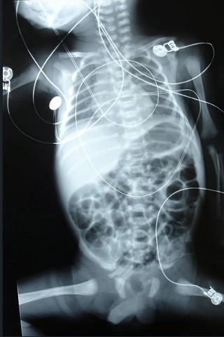 X-rays