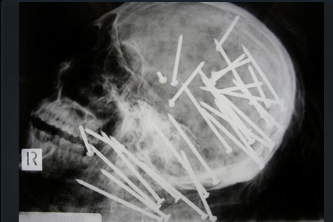 X-rays